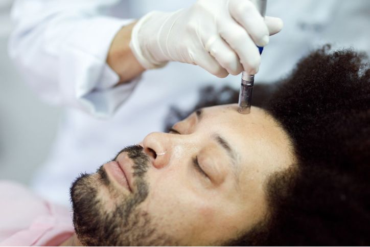 How Microneedling And Chemical Peels Offer Effective Scar Treatment