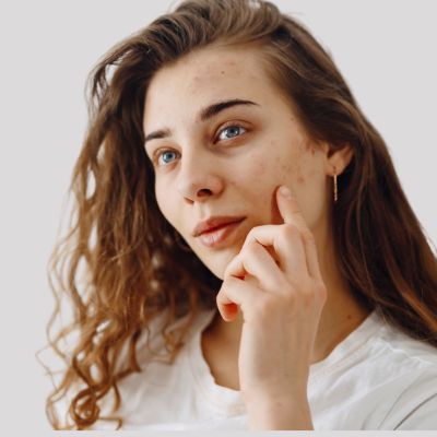 Chemical Peel Treatments