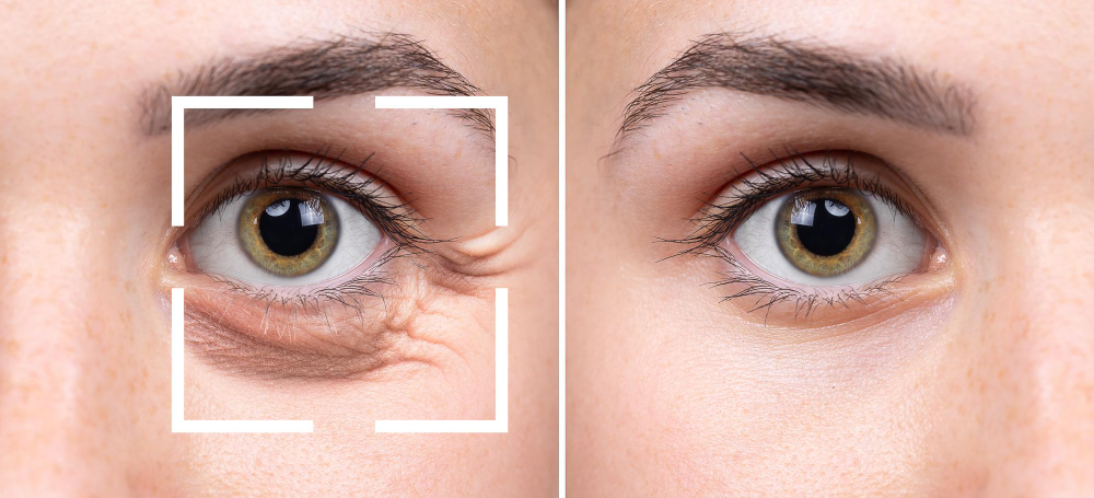 Before Eye Bag Surgery, Consider What’s Actually Causing Them